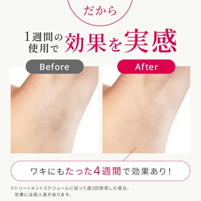 【クーポン利用で64,800円 → 42,120円+2/20～25はポイント最大12倍！2/19～2/25】脱毛器 Ulike 公式 Air10 IPL 光美容器 脱毛 サファイア美容器 冷却機能 SHRモード 顔 ワキ ヒゲ 自宅ケア 女性 男性 光美容機 家庭用 全身用 ギフト VIO