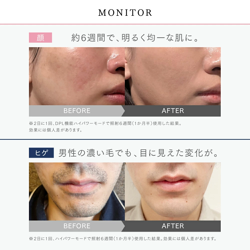 【公式｜25日限定 30%OFFクーポン！】リンチーリン愛用 脱毛器 MYTREX MiRAY ムダ毛ケア IPL DPL 美肌ケア サロン級 フラッシュ式 脱毛機 家庭用脱毛器 光脱毛器 美顔器 業務仕様 角質 ハリ ツヤ くすみ 透明肌 うぶ毛 顔 ワキ 髭 ひげ VIO対応 セルフ脱毛 男女兼用