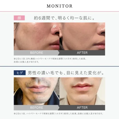 【公式｜25日限定 30%OFFクーポン！】リンチーリン愛用 脱毛器 MYTREX MiRAY ムダ毛ケア IPL DPL 美肌ケア サロン級 フラッシュ式 脱毛機 家庭用脱毛器 光脱毛器 美顔器 業務仕様 角質 ハリ ツヤ くすみ 透明肌 うぶ毛 顔 ワキ 髭 ひげ VIO対応 セルフ脱毛 男女兼用