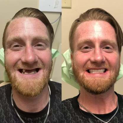 Easy Denture™ kerámia kompozit szilikon állítható univerzális fogpótlás