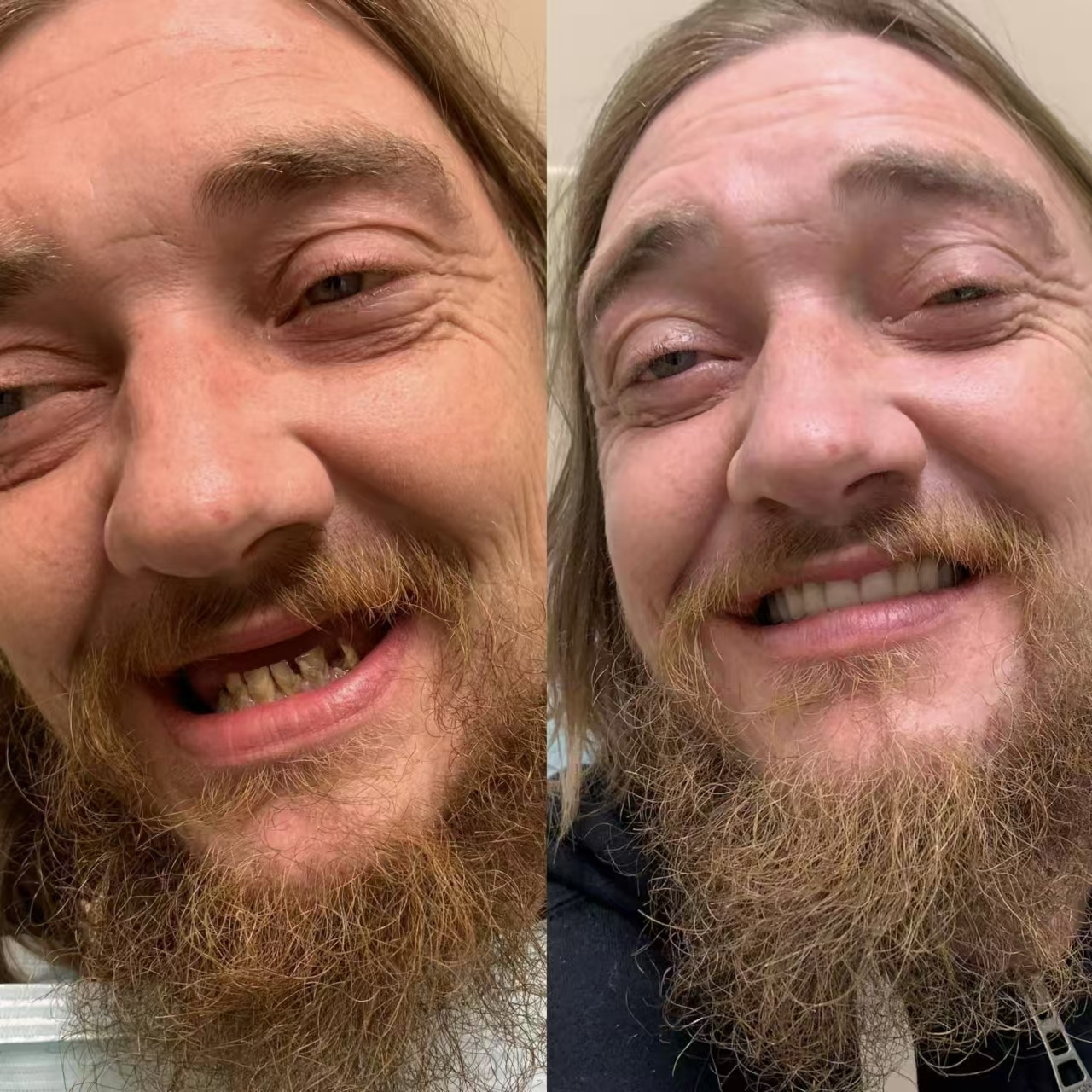 Easy Denture™ kerámia kompozit szilikon állítható univerzális fogpótlás