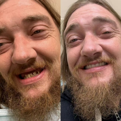 Easy Denture™ kerámia kompozit szilikon állítható univerzális fogpótlás