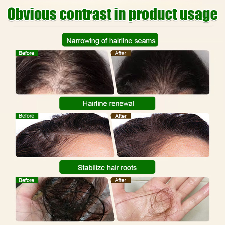 💥Order now and enjoy 50% off! Say goodbye to hair loss! Get thick, shiny hair with just three uses! Half price!