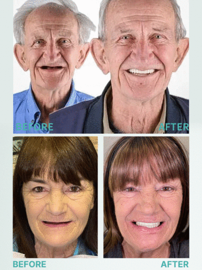 Soft silicone fits any denture 😊, offering wear as comfortable as real teeth 🦷. These mouthguards are used in renowned European dental clinics 🏥 and are now 50% off 🎉