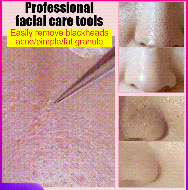 Made of medical-grade stainless steel, the 145° angle helps remove blackheads and dead skin cells from the face.  The fine, arc-shaped tweezers precisely fit the shape of your nose, gently pinching to remove from the root, leaving no residue! Gentle and n