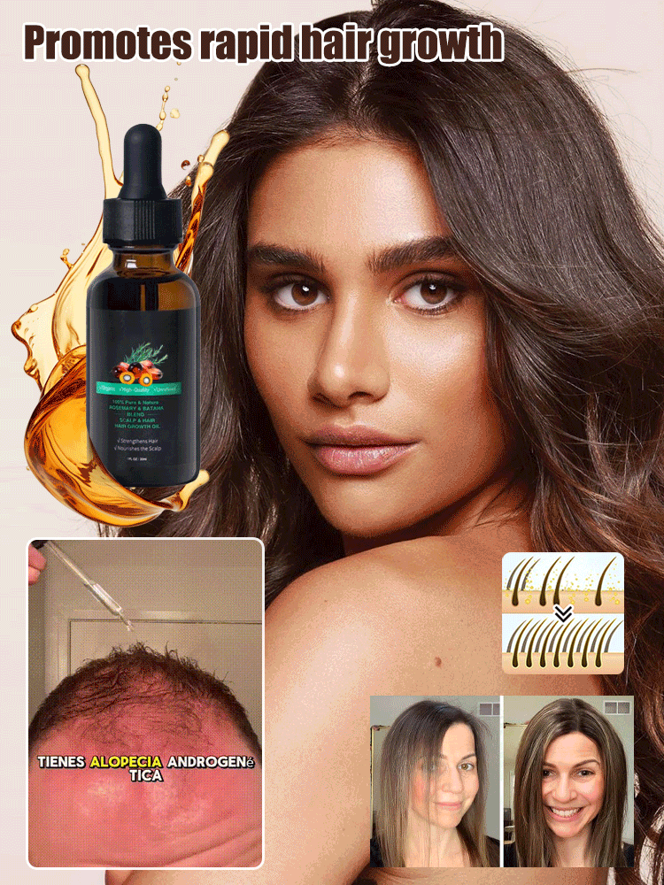 Rosemary Batanay Oil Hair Growth Essential Oil--Tired of dry, brittle, or thinning hair that just won’t grow? 😩