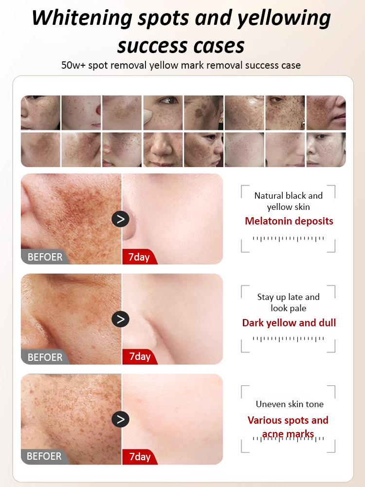 【15-day freckle removal】377 Whitening and freckle removal water light mask