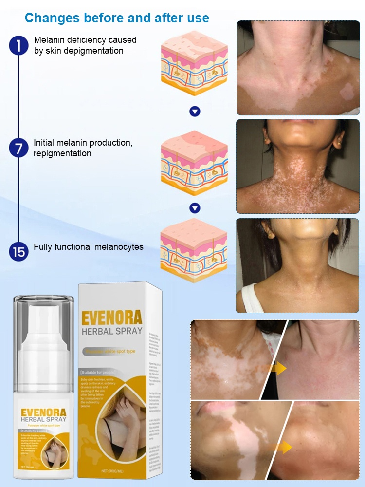 HOUKEA Herbal Spray for White Spots