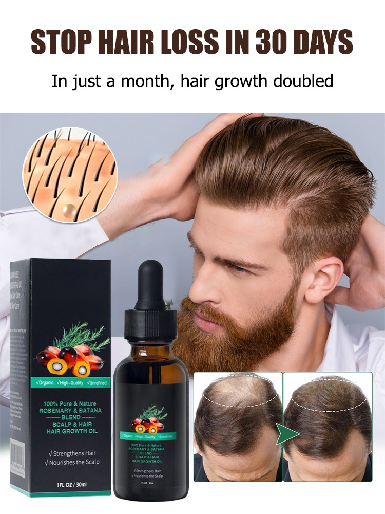 Rosemary Batanay Oil Hair Growth Essential Oil--Tired of dry, brittle, or thinning hair that just won’t grow? 😩