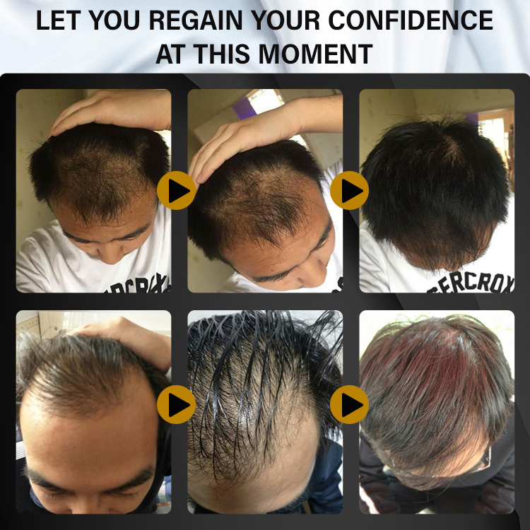 New upgrade version - Hair Growth Serum, boost your hair grows faster