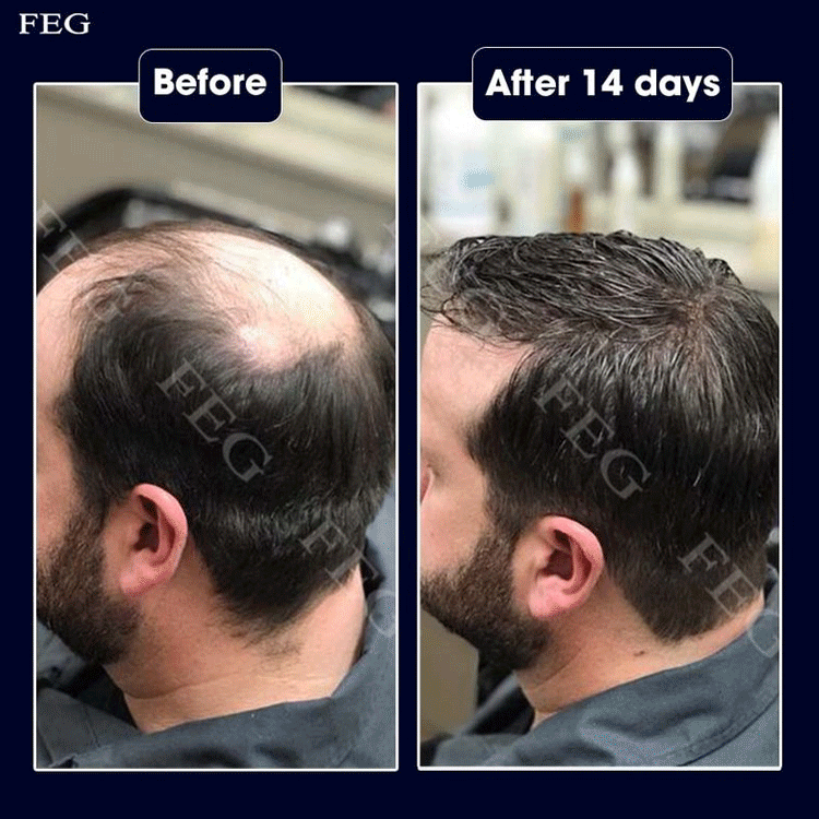 New upgrade version - Hair Growth Serum, boost your hair grows faster