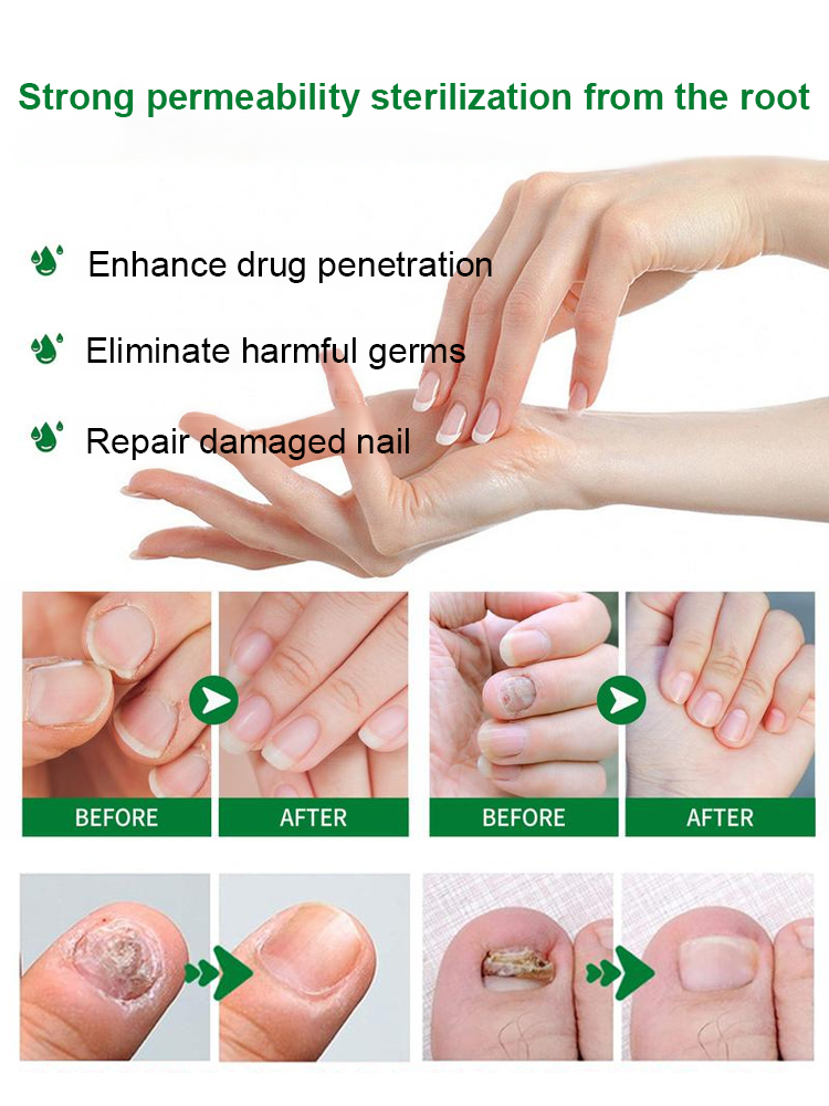 Say Goodbye To Ugly Nail Fungus — In Just 7 Days! Introducing Care Solution Our advanced formula targets nail fungus at the root, promoting healthy nail growth while protecting the surrounding skin. 