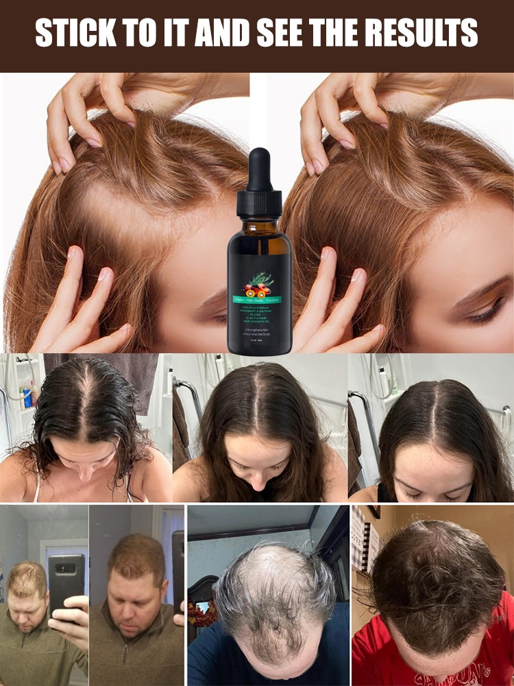 Rosemary Batanay Oil Hair Growth Essential Oil--Tired of dry, brittle, or thinning hair that just won’t grow? 😩