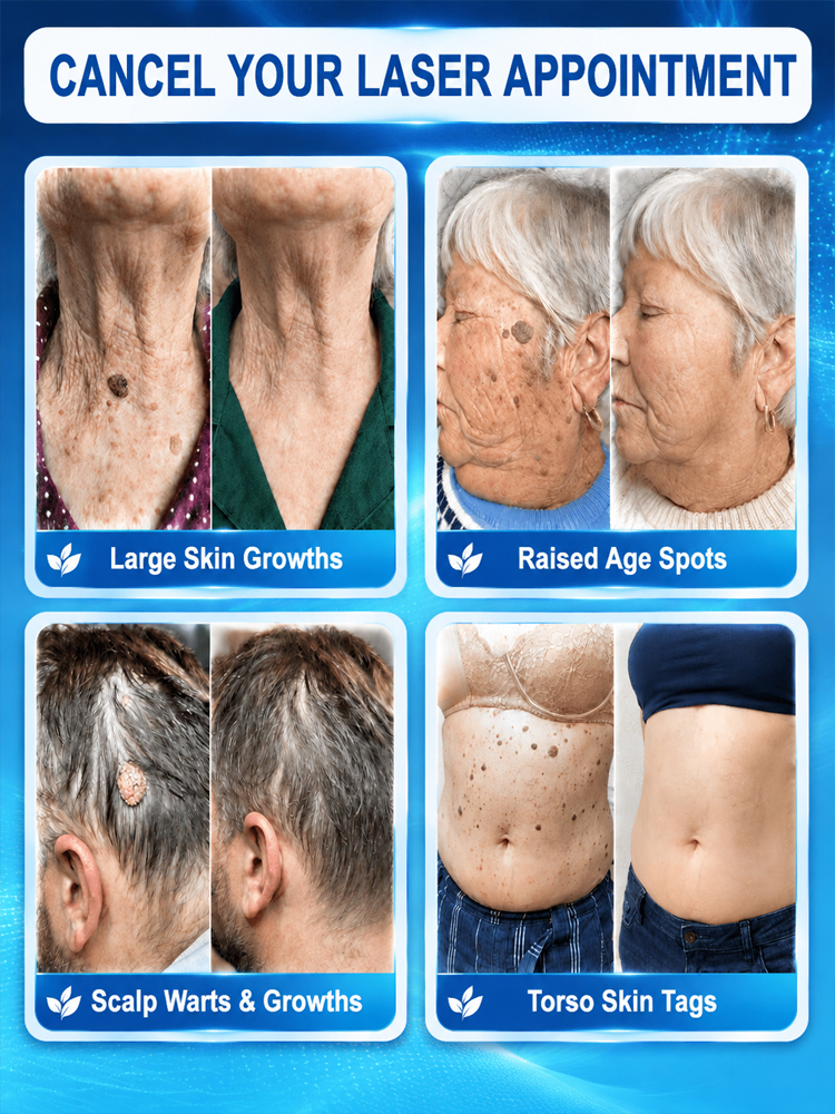 🚀 Precision Roll-On: 7 days to clear skin, No more painful warts!