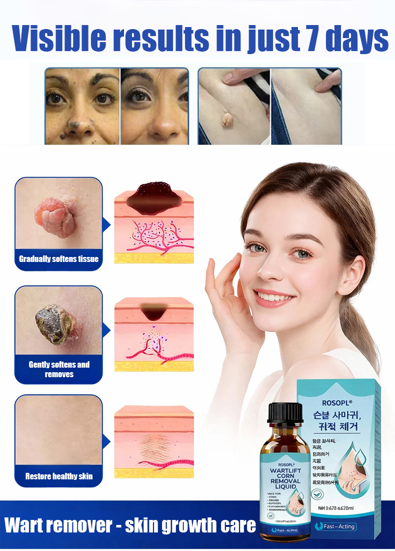 Wart removal liquid
