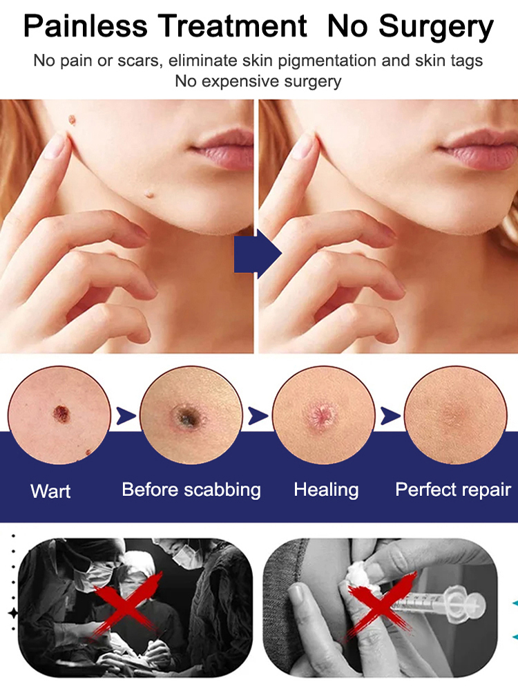 Ice Sensation Painless Wart Removal! Penetrates to the Root in 30 Seconds, No Damage to Healthy Skin – Money-Back Guarantee if Ineffective💯