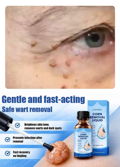 Wart removal liquid