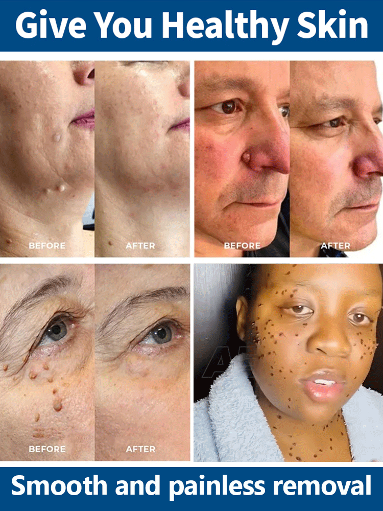 Ice Sensation Painless Wart Removal! Penetrates to the Root in 30 Seconds, No Damage to Healthy Skin – Money-Back Guarantee if Ineffective💯