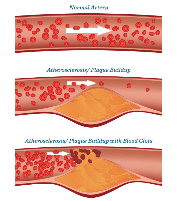 1702891856236652.png atherosclerosis.png