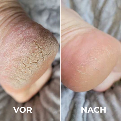 Professioneller Hornhautentferner