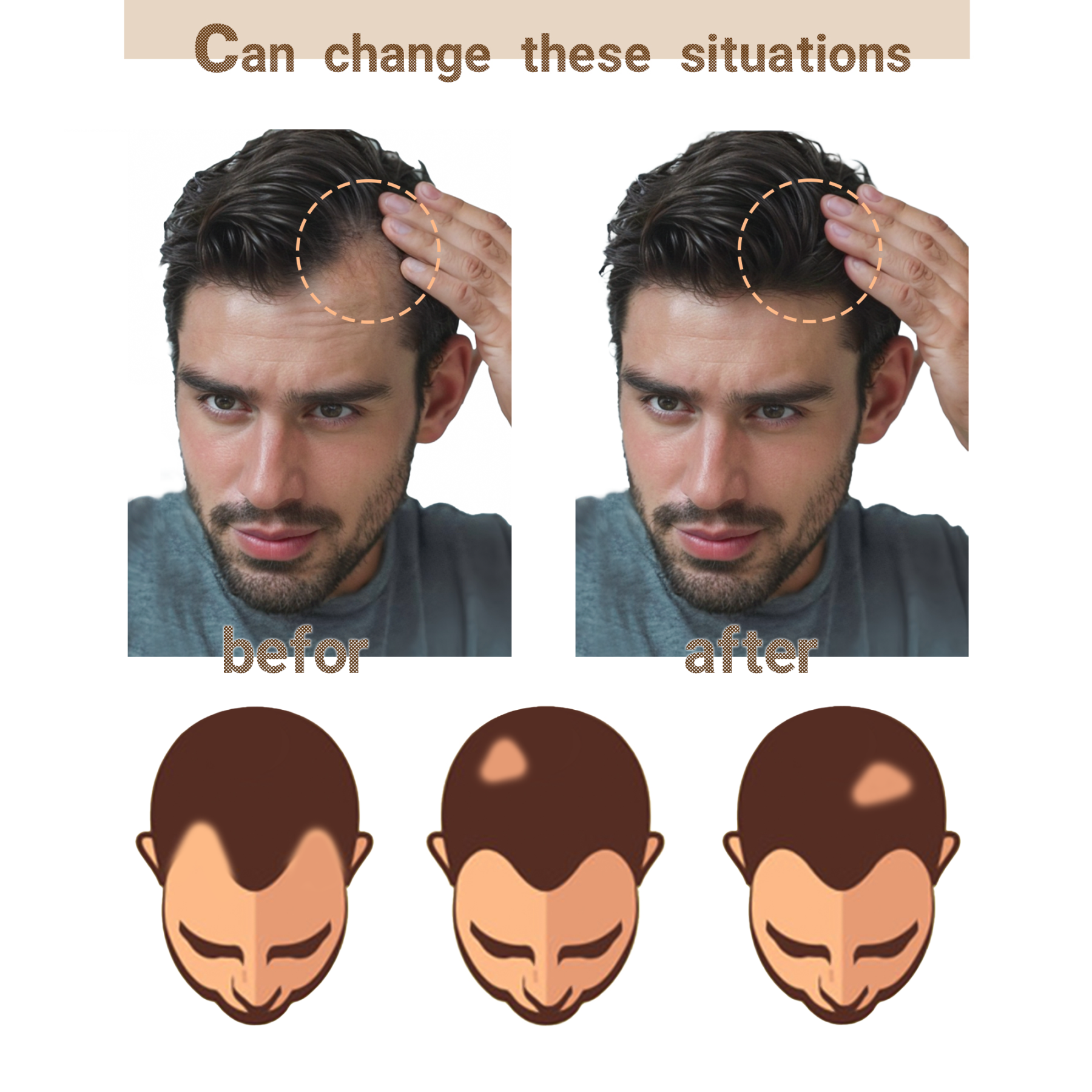 Meiverah Triangular alopecia Balding Spot Accidental Burns Scar Hair Replacement for men Hairline Loss Straight Tape in Replacement Toupee 2PC (2#)