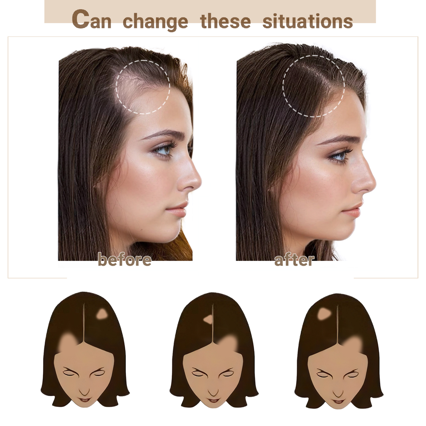 Meiverah Triangular alopecia Balding Spot Accidental Burns Scar Hair Replacement for women Hairline Loss Straight Tape in Replacement Toupee 2PC (1B#)