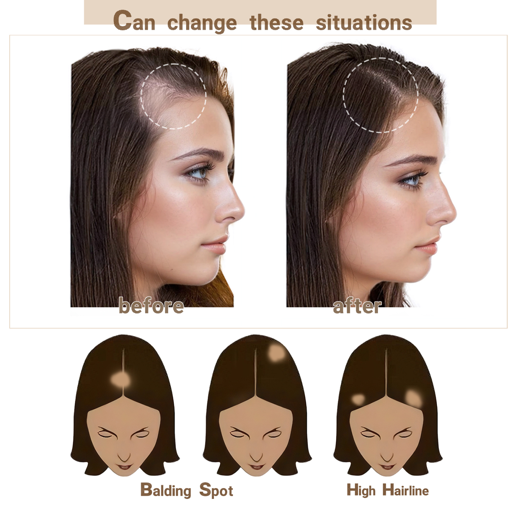 Meiverah Hair scar human hair replacement Accidental burns without hair for men women Hairline Loss Straight Tape in Replacement Toupee (Dark Brown)