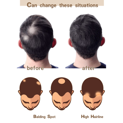 Meiverah Hair scar human hair replacement Accidental burns without hair for men Hairline Loss Straight Tape in Replacement Toupee (95% Pepper Salt)