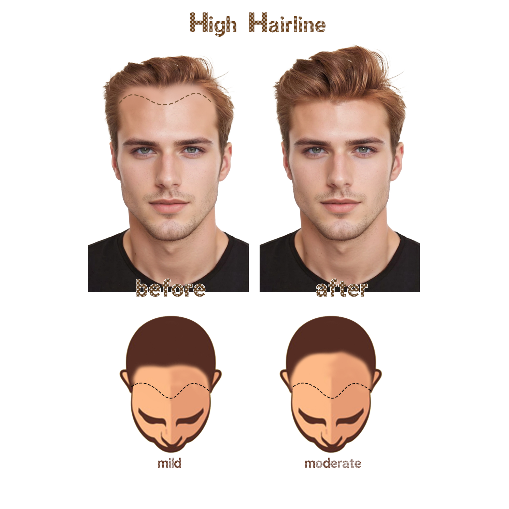 Meiverah Hair Frontal Hairpiece for Men Natural Black Hair Extension Hairline Loss Straight Tape in Human Hair Toppers Replacement Toupee （Pepper Salt）