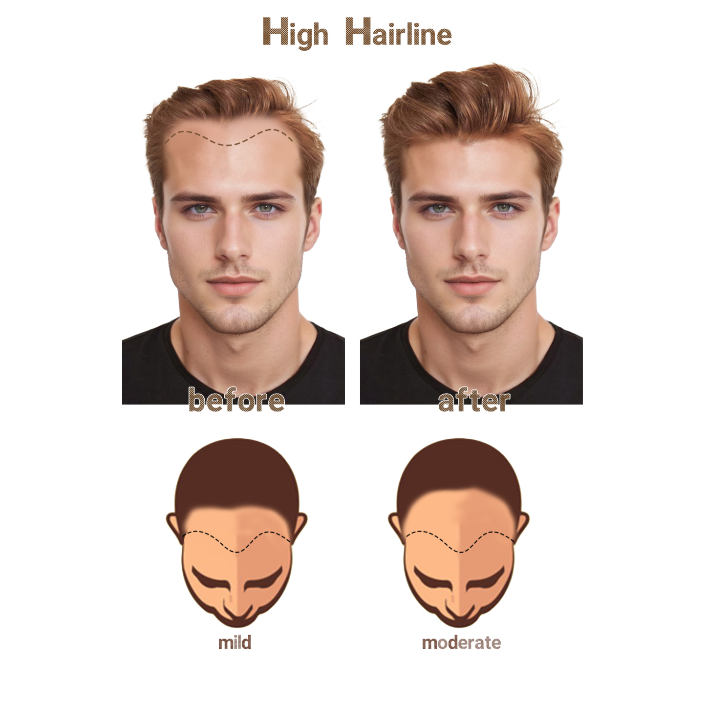Meiverah Hair Frontal Hairpiece for Men Natural Black Hair Extension Hairline Loss Straight Tape in Human Hair Toppers Replacement Toupee （Pepper Salt）