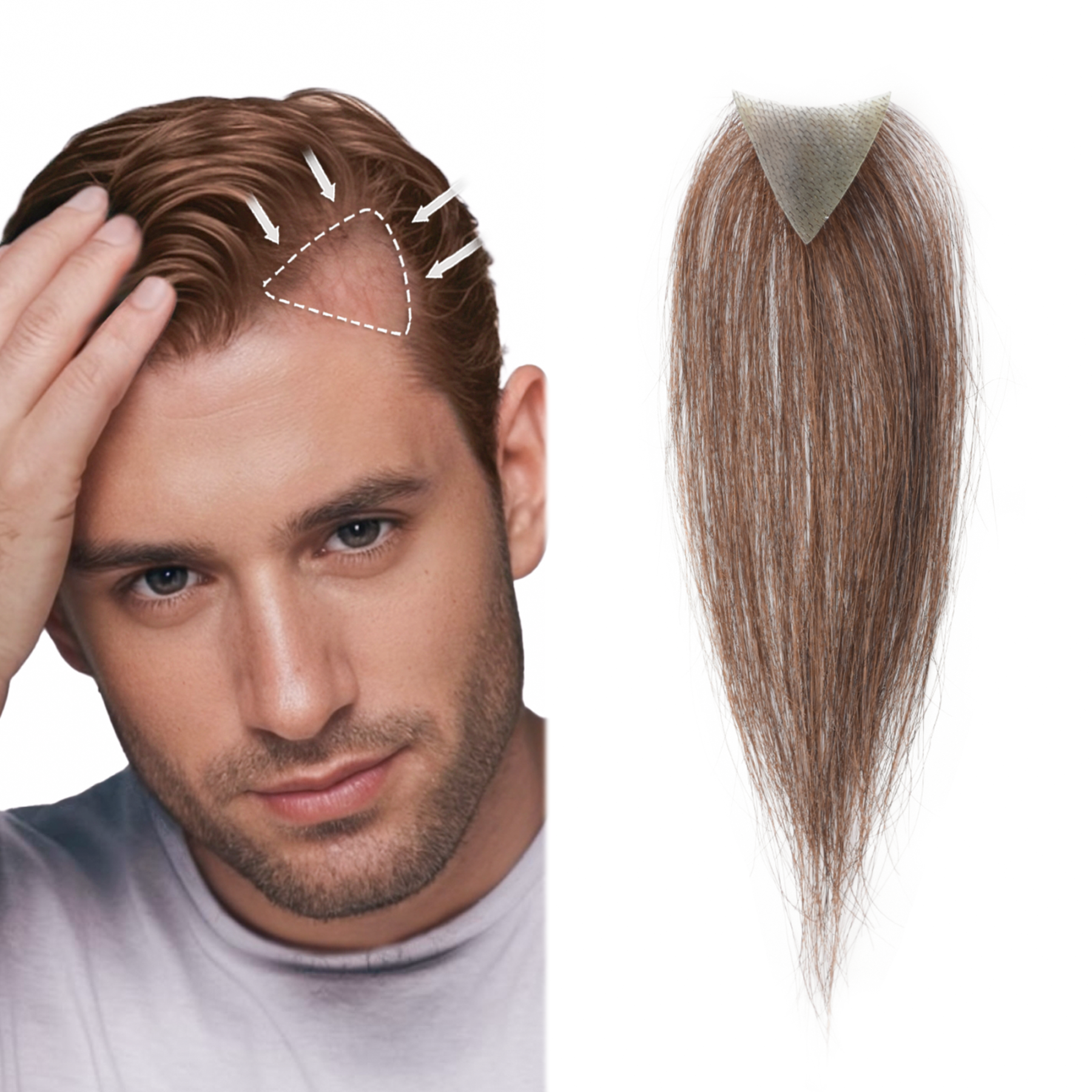 Meiverah Triangular alopecia Balding Spot Accidental Burns Scar Hair Replacement for men Hairline Loss Straight Tape in Replacement Toupee 2PC (Medium Brown#)