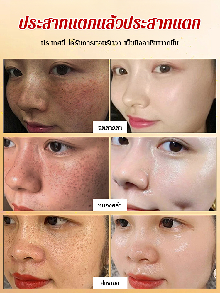 [โดยเฉพาะสำหรับจุดด่างดำที่ดื้อรั้น] น้ำมันเอสเซนส์ป้องกันฝ้าที่ได้รับการอัพเกรด