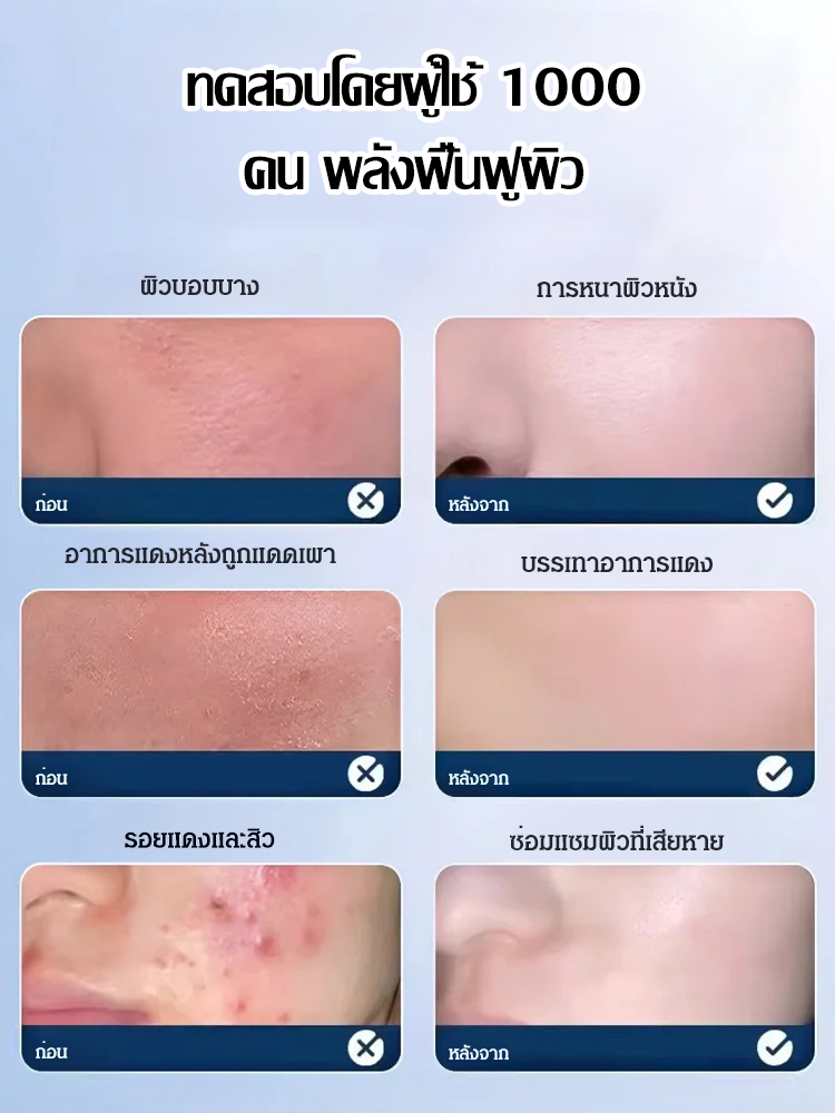 【ครีมให้ความชุ่มชื้นพร้อมช่วยลดรอยสิว】วิตามินบี5