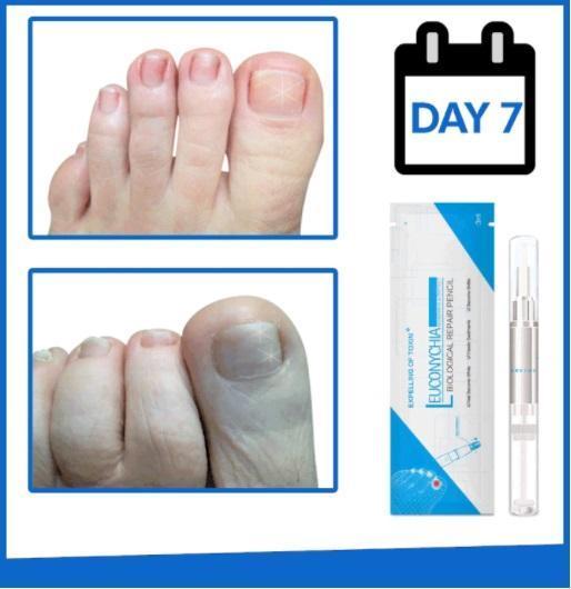 Advanced Fungal Nail Repair Pen