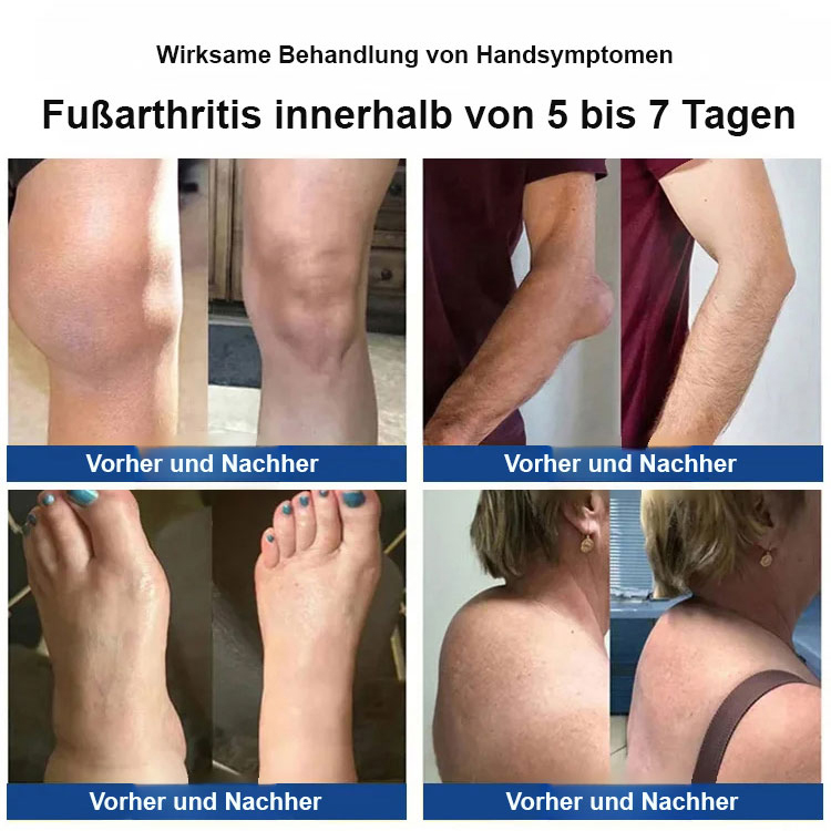 7 Tage Abschied von Gelenkschmerzen💪, Bienengift-Gelenkreparaturcreme, ab 35 €