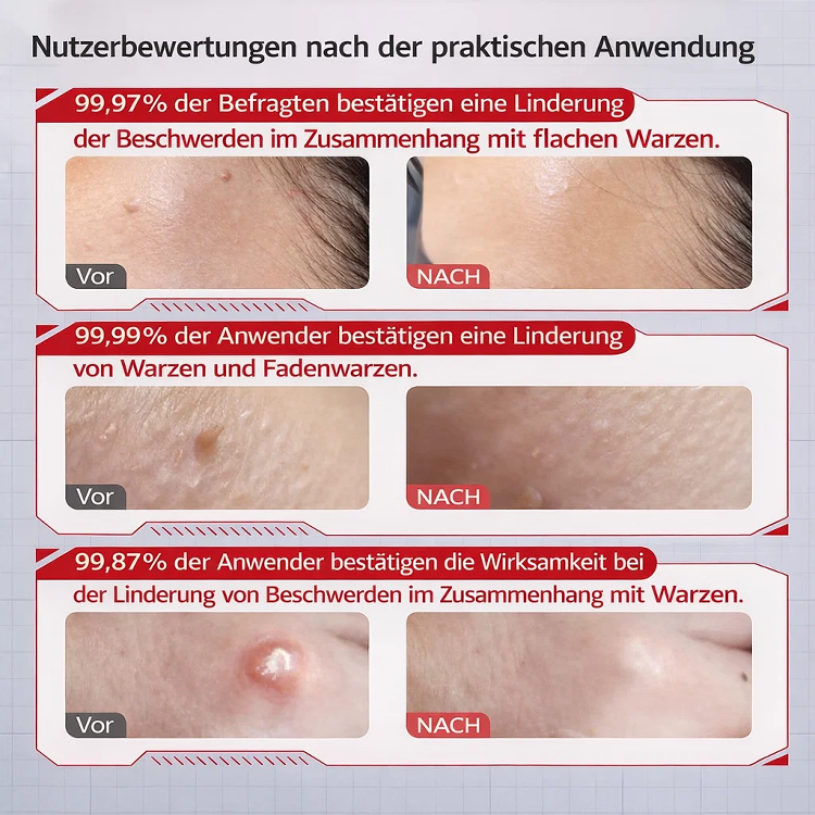 ✅ Seit 27 Jahren von Dermatologen empfohlen! Medizinische Warzencreme für Erwachsene und Senioren 🩹