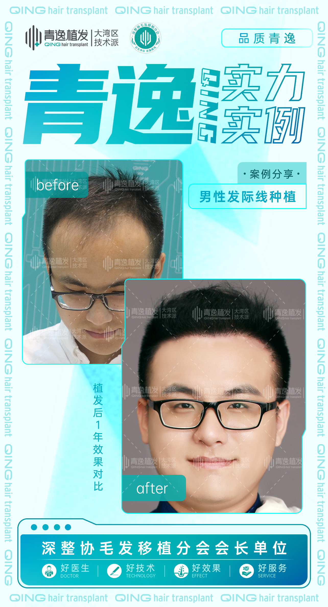 植髮嘅成活率有幾高？-青逸植髮