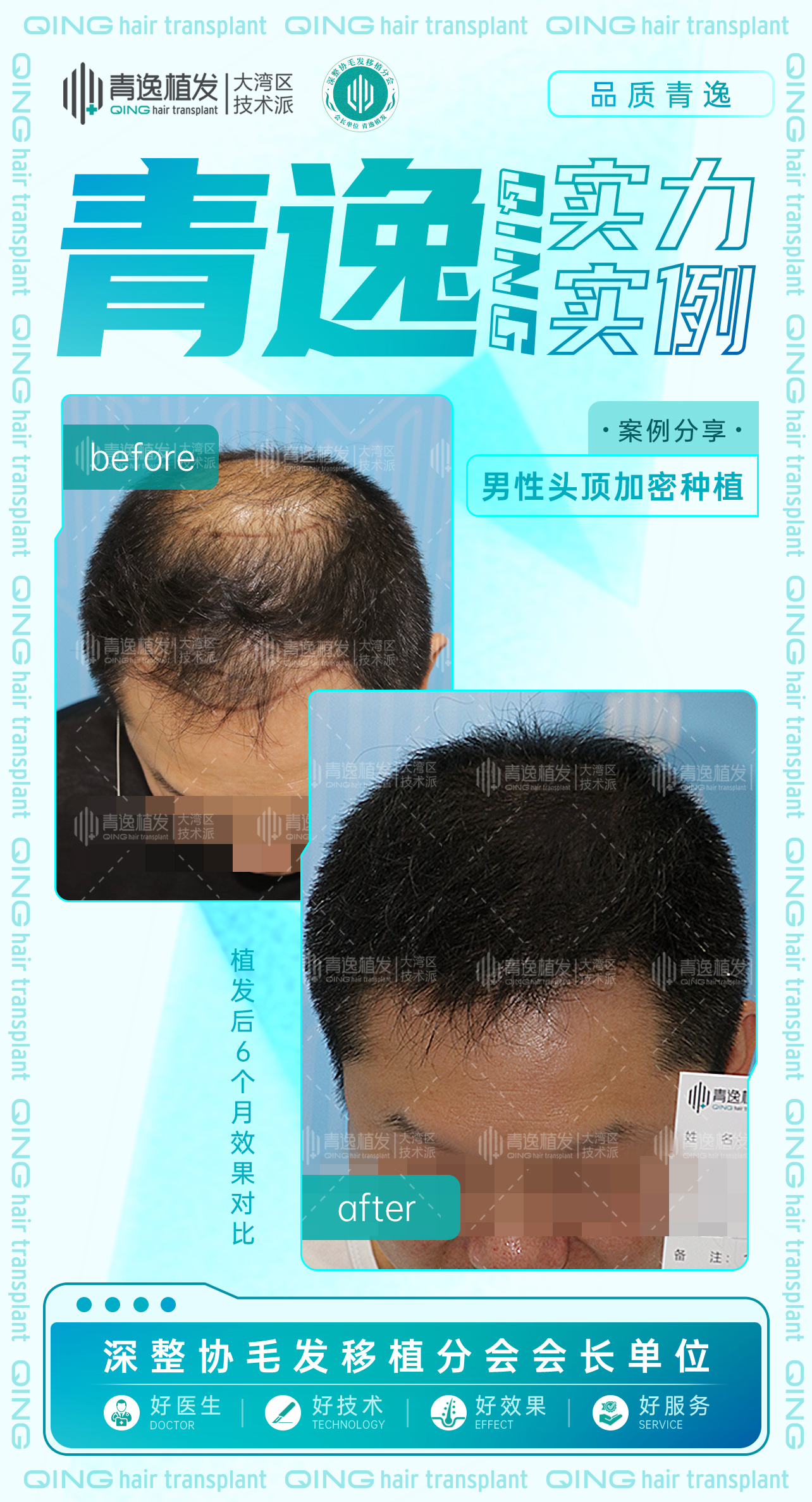 植髮三大伏位：真假微針技術、真假不剃髮技術、低價陷阱-青逸植髮