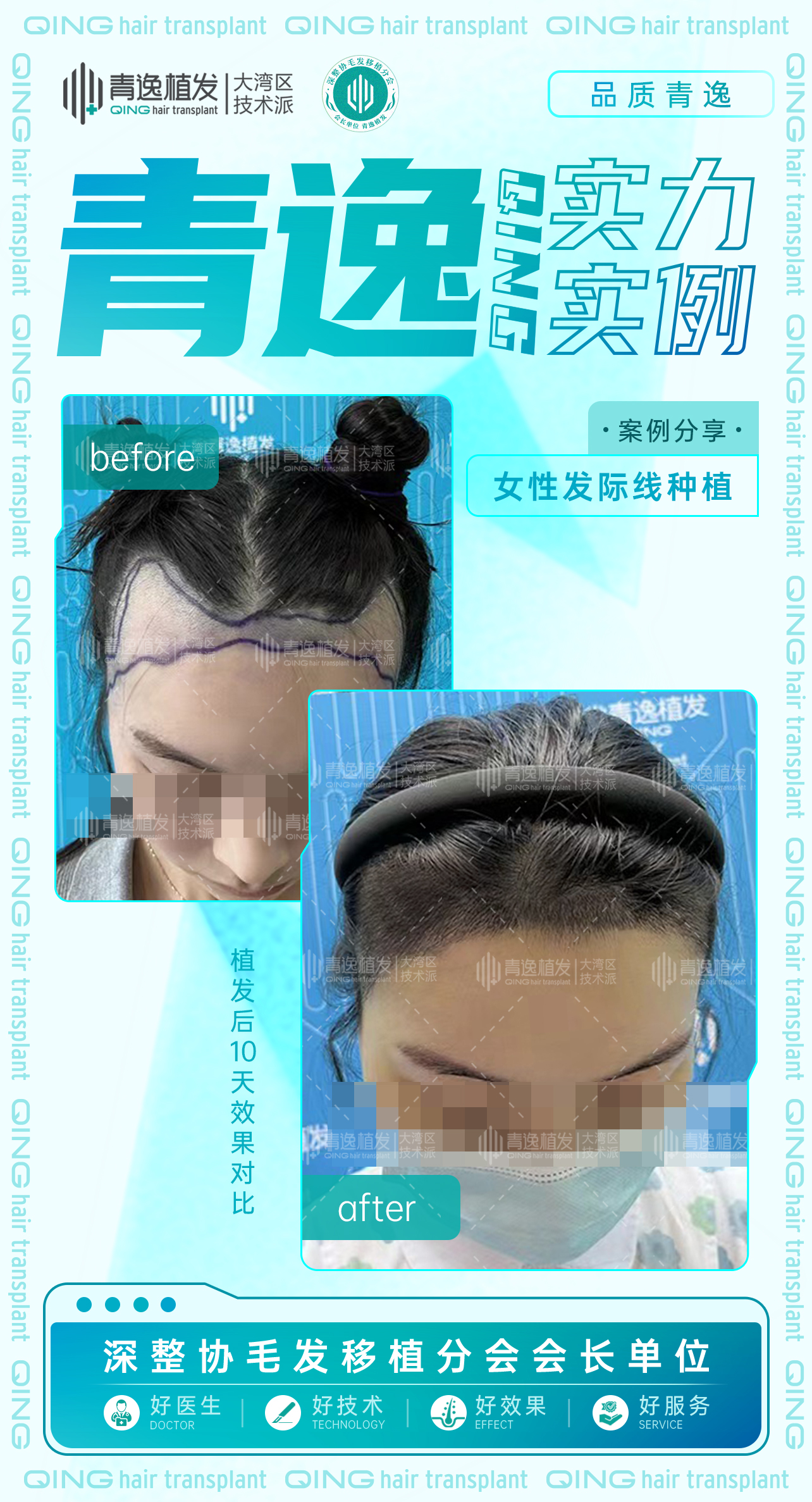 植髮前必讀！6大關鍵決定你的植髮效果與費用-青逸植髮
