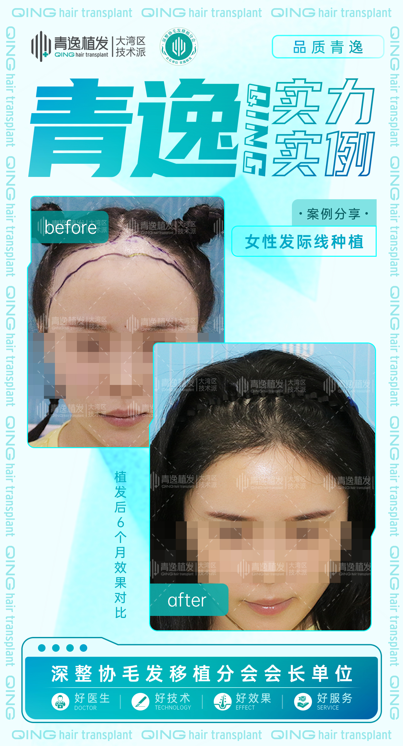2025年最新🌟 香港植髮全攻略：價格解析、技術選擇與診所挑選指南-青逸植髮