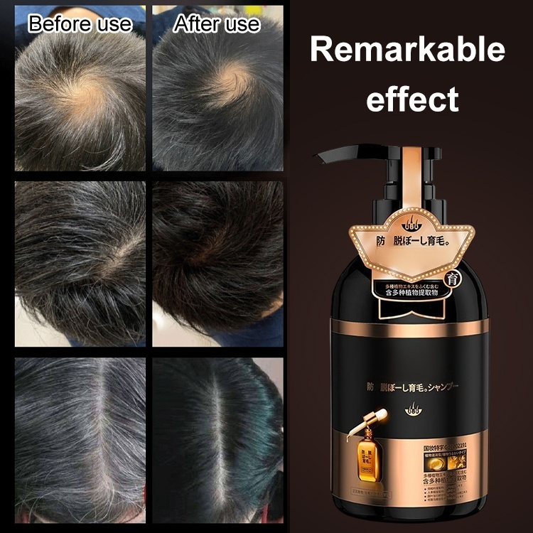 10 years of hair loss can regrow overnight, completely natural and harmless to the scalp! 🌿✨