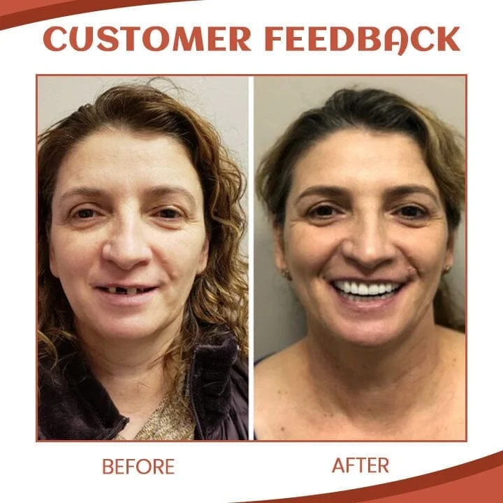 🎁 Easy Use Silicone Reline Kit for Dentures (✨BUY 2 GET 1 FREE💕)-PLAWLTD