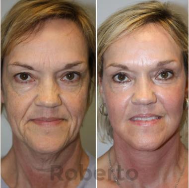 🔥HOT SALE-PLAWLTD™ Anti-Aging Device-PLAWLTD