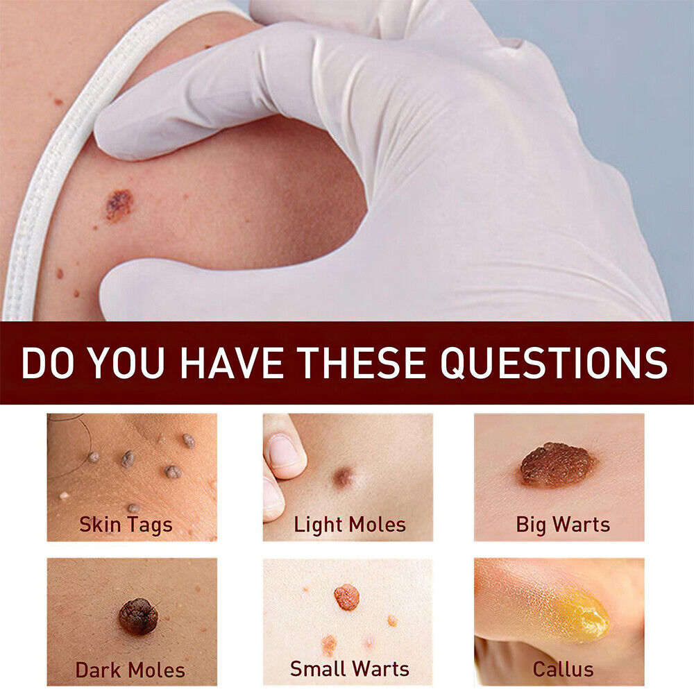 ✨Tags & Moles Remover-PLAWLTD