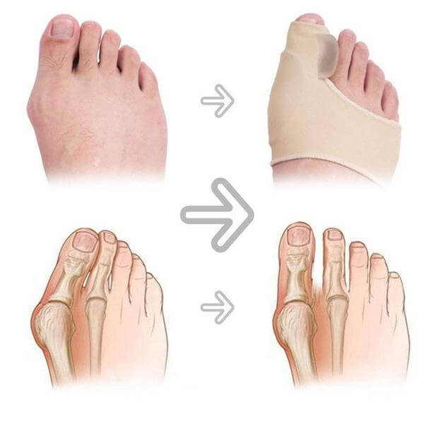 Premium Bunion Corrector Sock