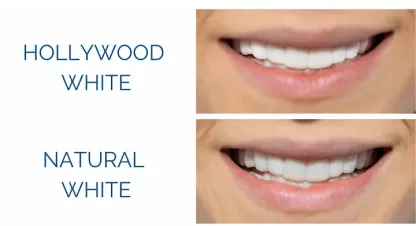 💝Last day discount-75%Off💝Latest👨‍⚕Adjustable Snap-On Dentures😁-PLAWLTD