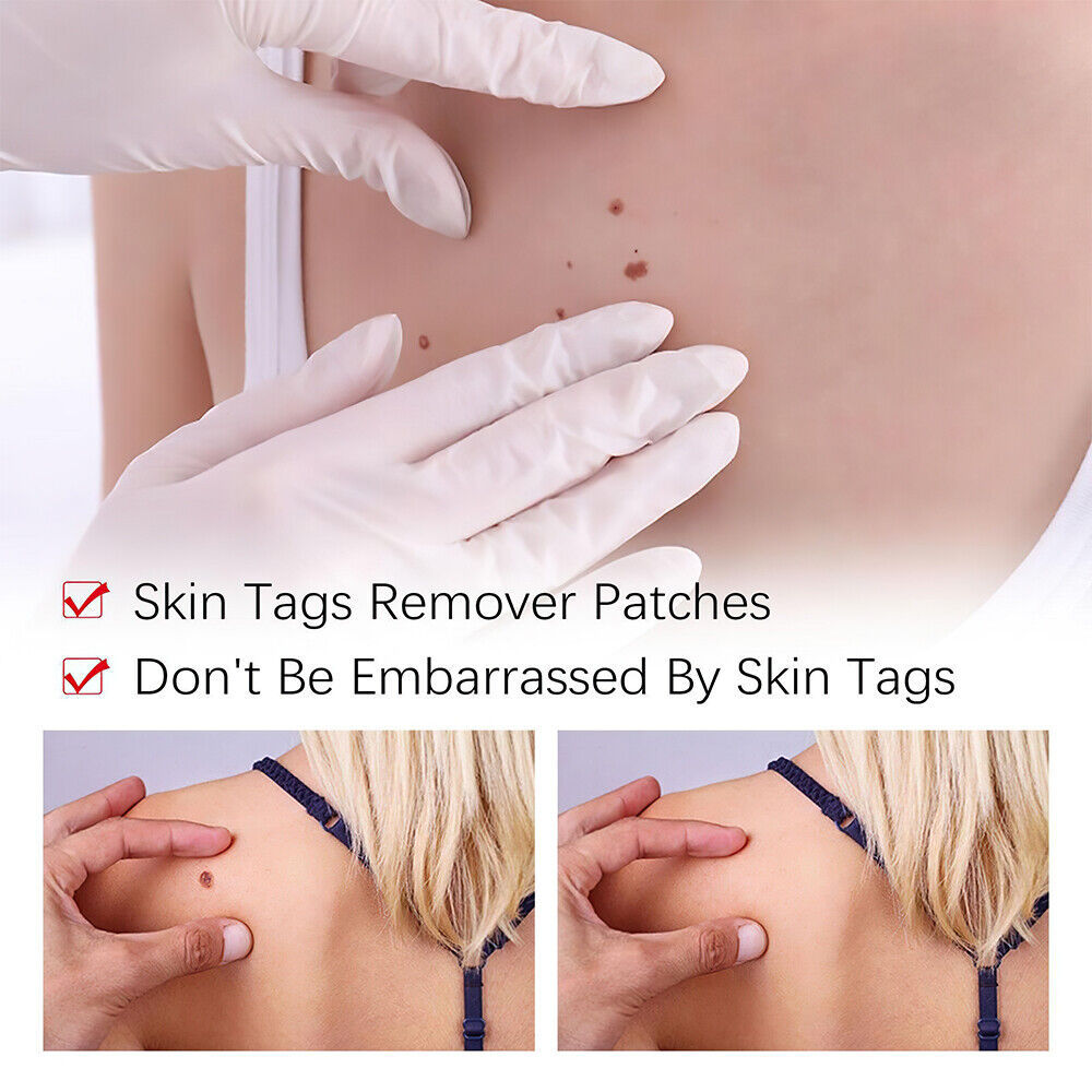 ✨Tags & Moles Remover-PLAWLTD
