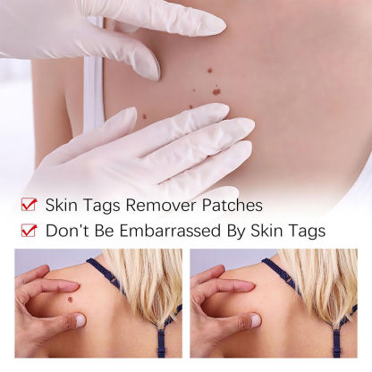 ✨Tags & Moles Remover-PLAWLTD