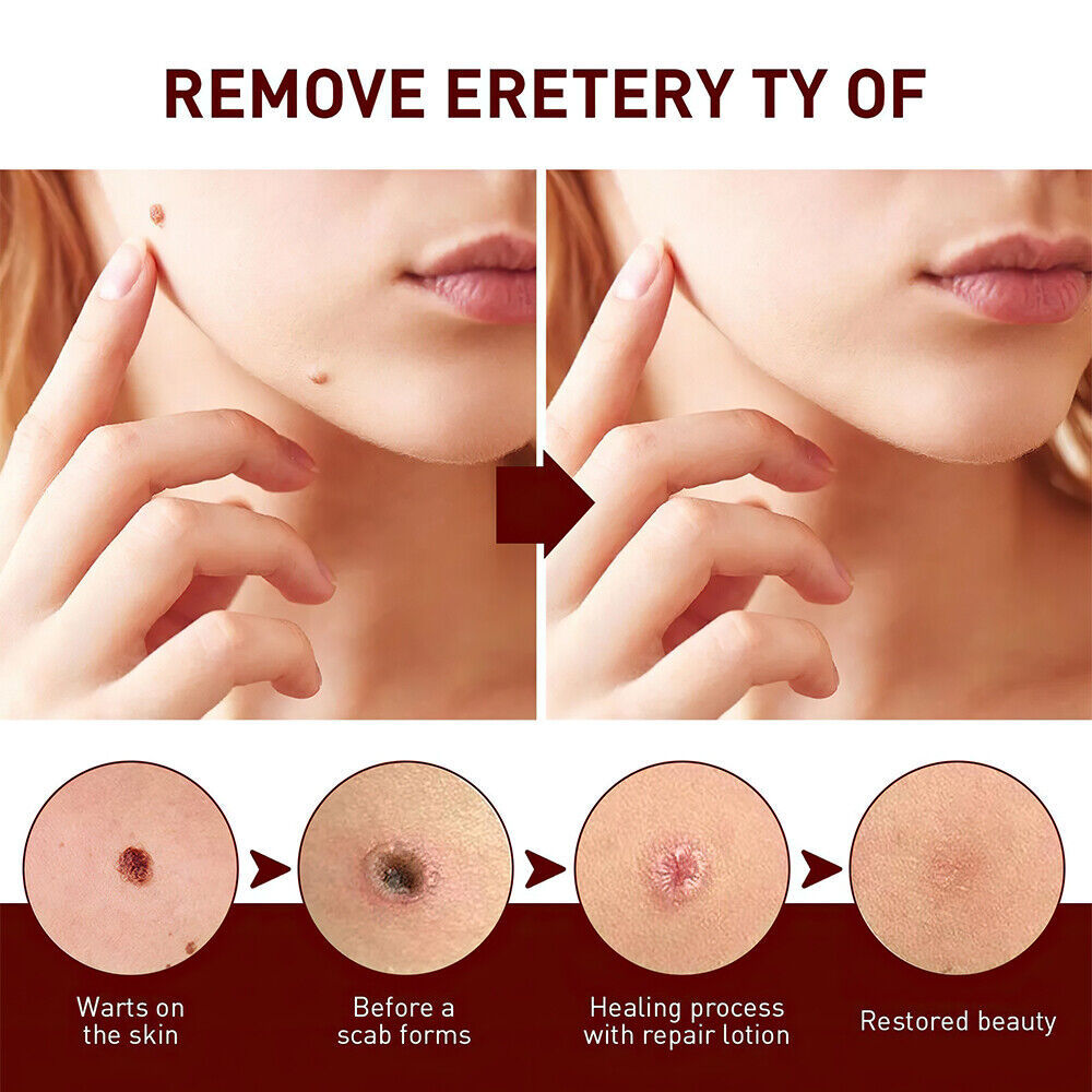 ✨Tags & Moles Remover-PLAWLTD