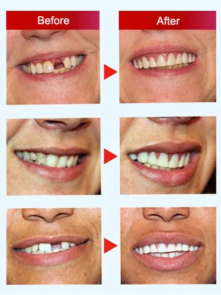 100,000 sets of braces were sold as soon as they were launched, highly recommended by dental doctors